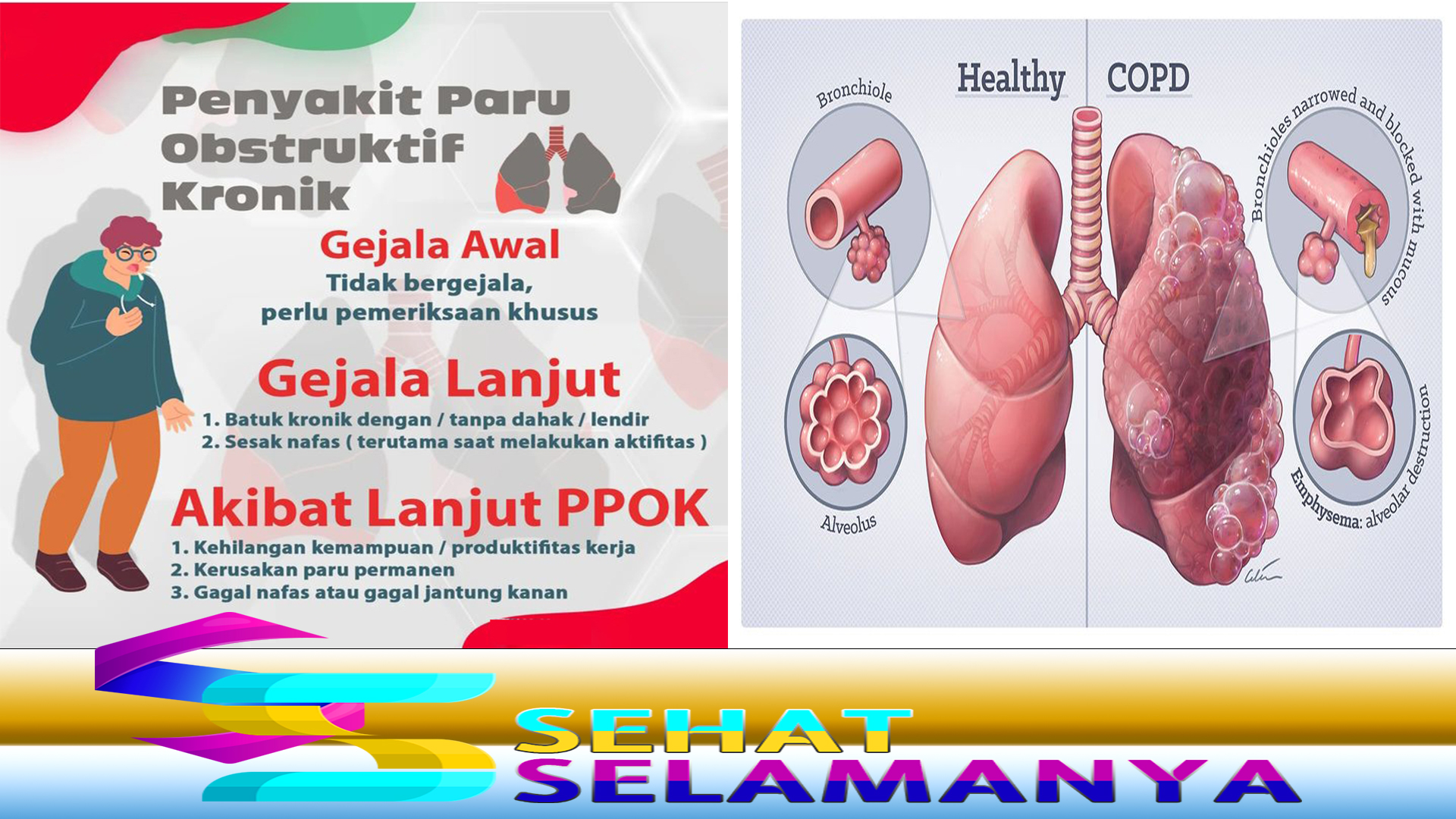 Mengenal Gejala PPOK dan Penanganannya