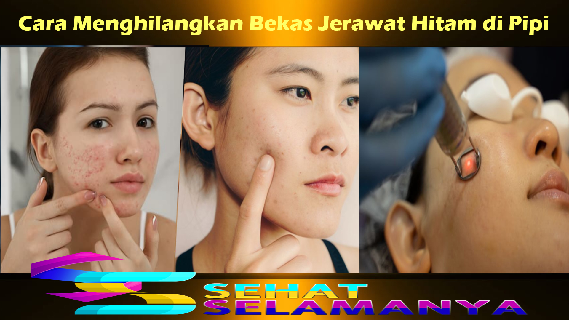 Cara Menghilangkan Bekas Jerawat Hitam di Pipi
