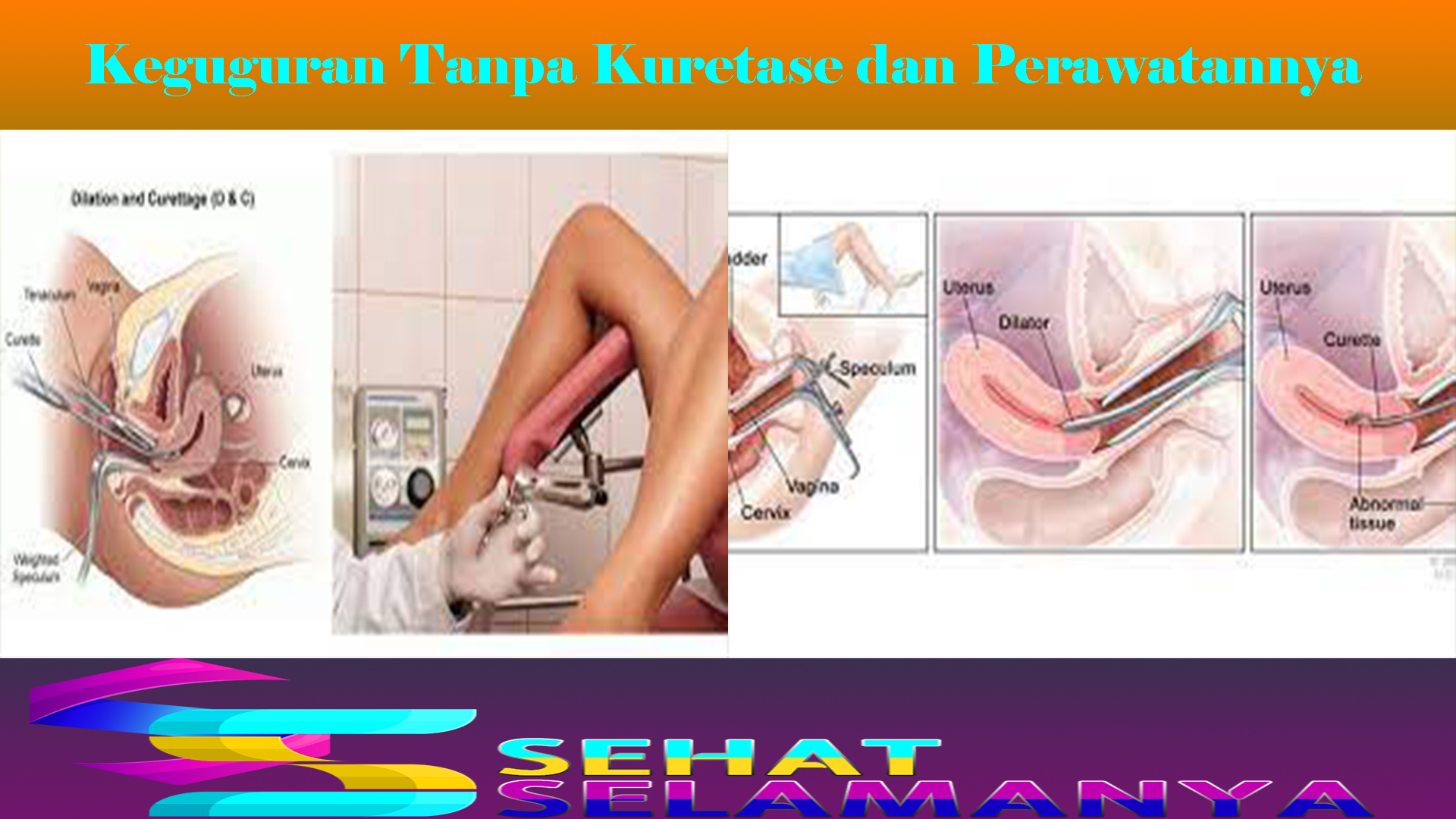 Keguguran Tanpa Kuretase dan Perawatannya