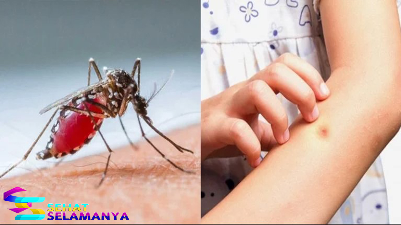 Berbagai Cara Menghilangkan Bekas Gigitan Nyamuk