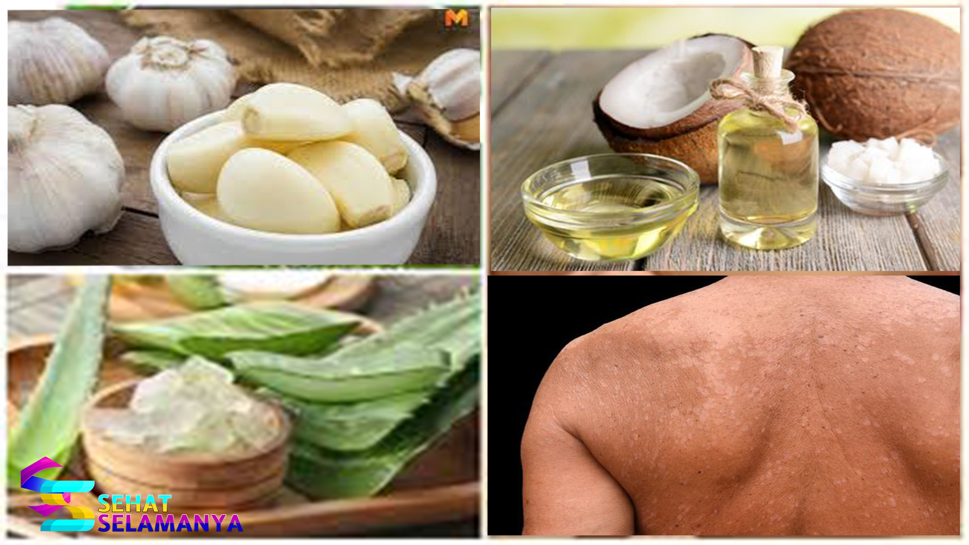 10 Obat Panu Alami yang Bisa Dicoba di Rumah
