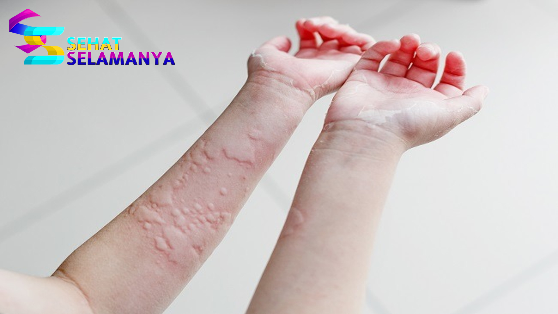 Cara Meringankan dan Mencegah Kaligata